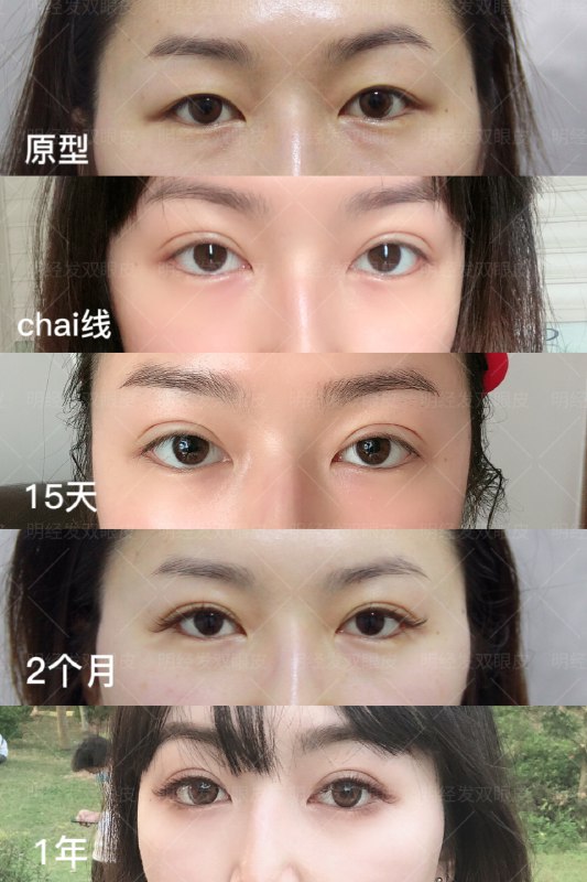 《双眼皮调整》精细调整双眼皮形态，打造自然灵动双眸